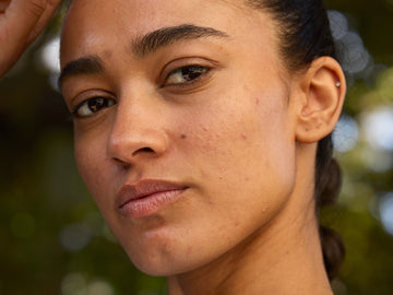 What Is Skin Purging and How Do You Know If It’s Happening?